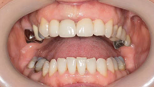 patient's teeth after at Victoria Clinic Dental Medical and Aesthetics Services