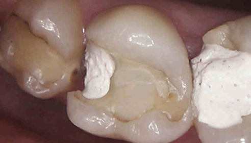 patient's teeth before at Victoria Clinic Dental Medical and Aesthetics Services