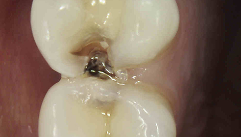 patient's teeth before at Victoria Clinic Dental Medical and Aesthetics Services