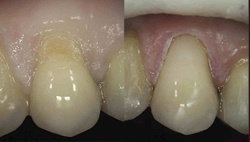 patient's teeth before and after at Victoria Clinic Dental Medical and Aesthetics Services