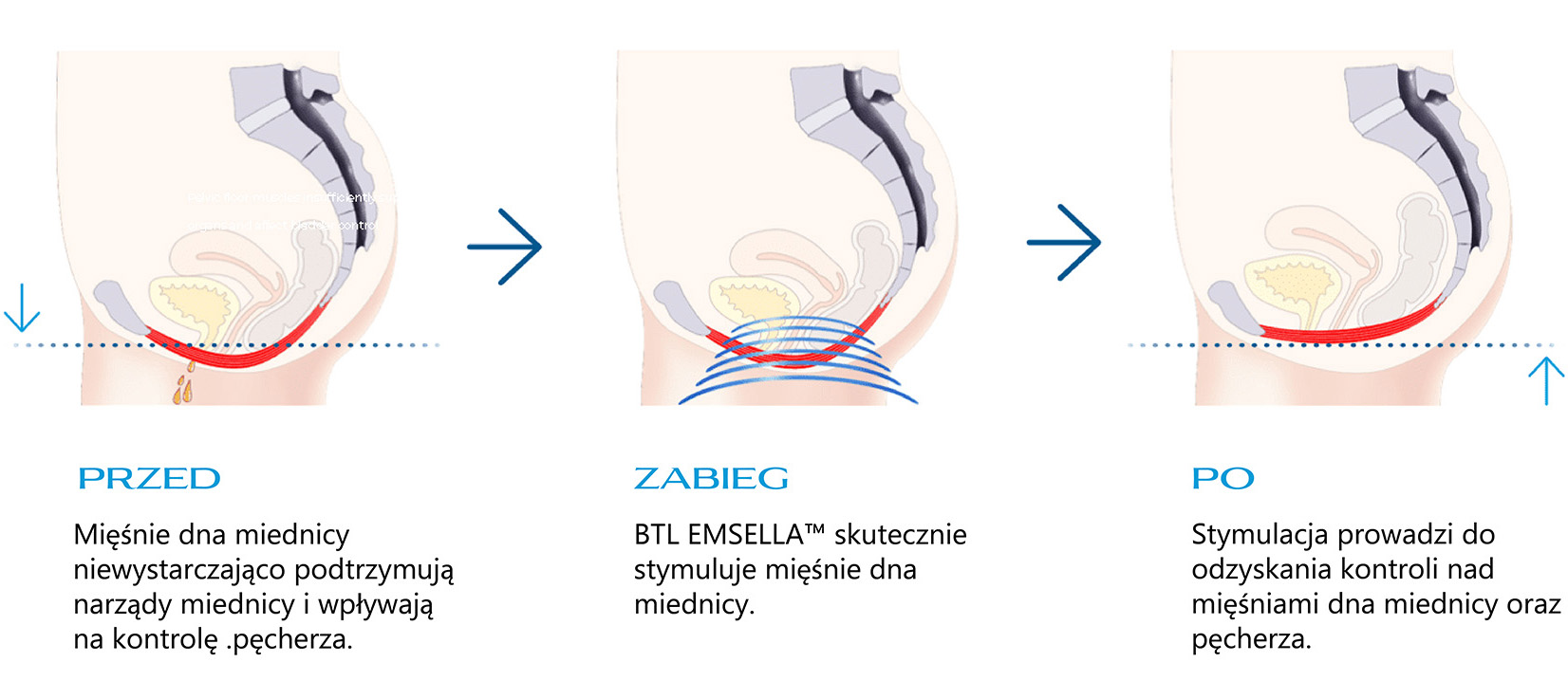 Emsella BTL Chair at Victoria Clinic Dental Medical and Aesthetics Services